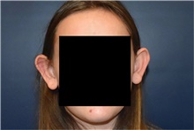 Ear Surgery Before Photo by Rachel Ruotolo, MD; Garden City, NY - Case 43392