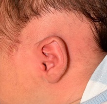 Ear Surgery Before Photo by Rachel Ruotolo, MD; Garden City, NY - Case 43397