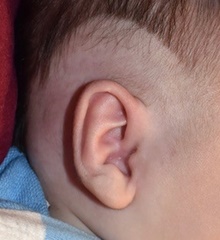 Ear Surgery After Photo by Rachel Ruotolo, MD; Garden City, NY - Case 43397