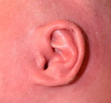 Ear Surgery After Photo by Rachel Ruotolo, MD; Garden City, NY - Case 43398