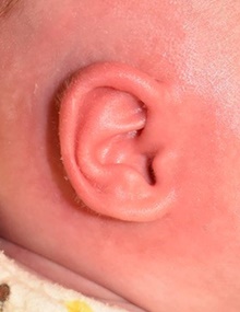 Ear Surgery After Photo by Rachel Ruotolo, MD; Garden City, NY - Case 43398