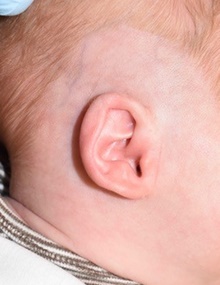 Ear Surgery Before Photo by Rachel Ruotolo, MD; Garden City, NY - Case 43398