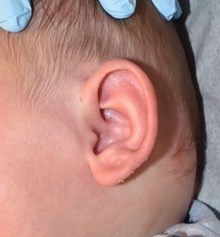 Ear Surgery After Photo by Rachel Ruotolo, MD; Garden City, NY - Case 43400