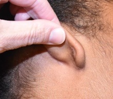 Ear Reconstruction Surgery After Photo by Rachel Ruotolo, MD; Garden City, NY - Case 43403