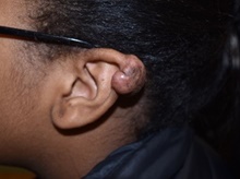 Ear Reconstruction Surgery Before Photo by Rachel Ruotolo, MD; Garden City, NY - Case 43403