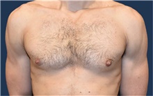 Male Breast Reduction After Photo by Rachel Ruotolo, MD; Garden City, NY - Case 43411