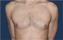 Male Breast Reduction Before Photo by Rachel Ruotolo, MD; Garden City, NY - Case 43411