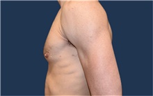 Male Breast Reduction After Photo by Rachel Ruotolo, MD; Garden City, NY - Case 43411