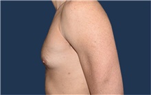 Male Breast Reduction Before Photo by Rachel Ruotolo, MD; Garden City, NY - Case 43411