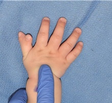 Hand Surgery for Congenital Differences Before Photo by Rachel Ruotolo, MD; Garden City, NY - Case 44939