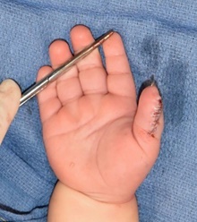 Hand Surgery for Congenital Differences After Photo by Rachel Ruotolo, MD; Garden City, NY - Case 44939