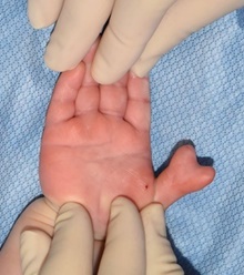 Hand Surgery for Congenital Differences Before Photo by Rachel Ruotolo, MD; Garden City, NY - Case 44939