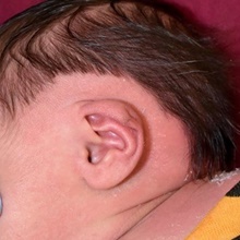 Ear Surgery Before Photo by Rachel Ruotolo, MD; Garden City, NY - Case 44941