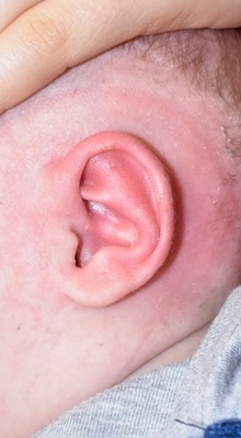 Ear Surgery After Photo by Rachel Ruotolo, MD; Garden City, NY - Case 44944