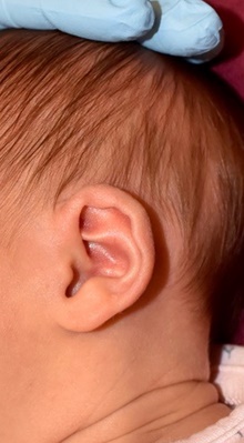 Ear Surgery Before Photo by Rachel Ruotolo, MD; Garden City, NY - Case 44944