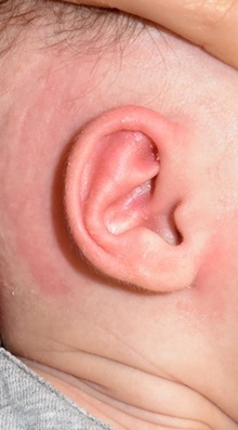 Ear Surgery After Photo by Rachel Ruotolo, MD; Garden City, NY - Case 44944