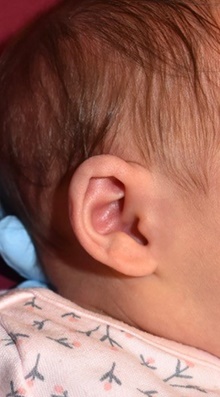 Ear Surgery Before Photo by Rachel Ruotolo, MD; Garden City, NY - Case 44944