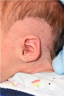 Ear Surgery Before Photo by Rachel Ruotolo, MD; Garden City, NY - Case 44949