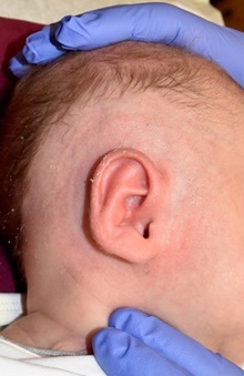 Ear Surgery After Photo by Rachel Ruotolo, MD; Garden City, NY - Case 44949