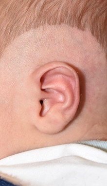 Ear Surgery Before Photo by Rachel Ruotolo, MD; Garden City, NY - Case 44950