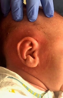 Ear Surgery After Photo by Rachel Ruotolo, MD; Garden City, NY - Case 44950