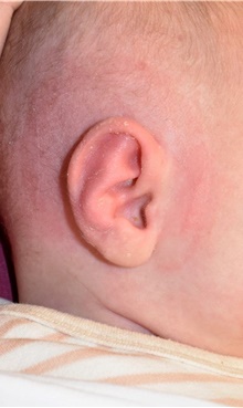 Ear Surgery After Photo by Rachel Ruotolo, MD; Garden City, NY - Case 44951