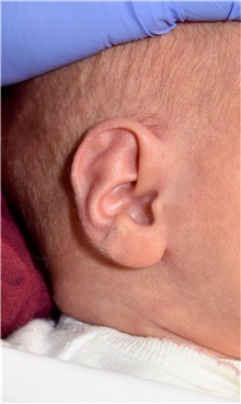 Ear Surgery Before Photo by Rachel Ruotolo, MD; Garden City, NY - Case 44951