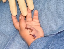 Hand Surgery for Congenital Differences After Photo by Rachel Ruotolo, MD; Garden City, NY - Case 44953