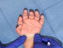 Hand Surgery for Congenital Differences Before Photo by Rachel Ruotolo, MD; Garden City, NY - Case 44953