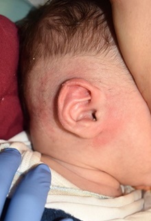 Ear Surgery After Photo by Rachel Ruotolo, MD; Garden City, NY - Case 44954
