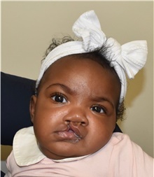 Cleft Lip and Palate Repair Before Photo by Rachel Ruotolo, MD; Garden City, NY - Case 44955