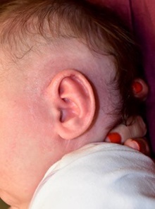 Ear Surgery After Photo by Rachel Ruotolo, MD; Garden City, NY - Case 44960