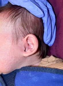 Ear Surgery Before Photo by Rachel Ruotolo, MD; Garden City, NY - Case 44960