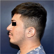 Rhinoplasty After Photo by Rachel Ruotolo, MD; Garden City, NY - Case 44962