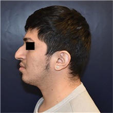 Rhinoplasty Before Photo by Rachel Ruotolo, MD; Garden City, NY - Case 44962