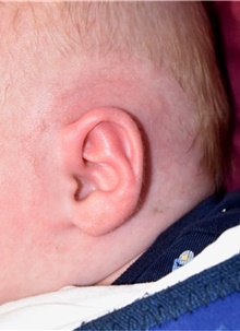 Ear Surgery After Photo by Rachel Ruotolo, MD; Garden City, NY - Case 44966