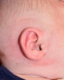 Ear Surgery After Photo by Rachel Ruotolo, MD; Garden City, NY - Case 44966