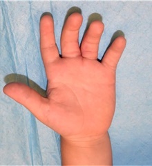 Hand Surgery for Congenital Differences After Photo by Rachel Ruotolo, MD; Garden City, NY - Case 44970