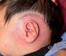 Ear Surgery After Photo by Rachel Ruotolo, MD; Garden City, NY - Case 44972