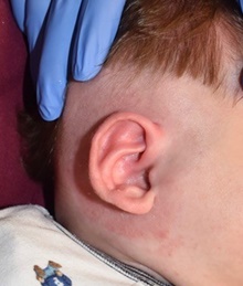 Ear Surgery After Photo by Rachel Ruotolo, MD; Garden City, NY - Case 44973
