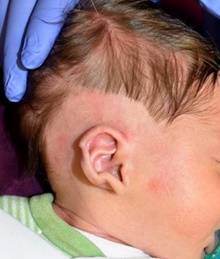Ear Surgery Before Photo by Rachel Ruotolo, MD; Garden City, NY - Case 44973