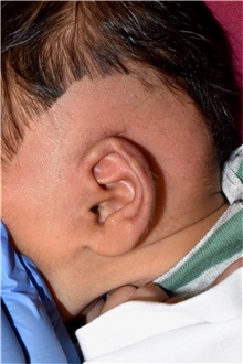 Ear Surgery Before Photo by Rachel Ruotolo, MD; Garden City, NY - Case 44976