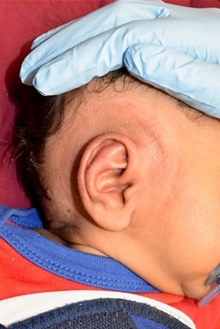 Ear Surgery After Photo by Rachel Ruotolo, MD; Garden City, NY - Case 44976