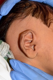 Ear Surgery Before Photo by Rachel Ruotolo, MD; Garden City, NY - Case 44976
