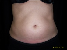 Nonsurgical Fat Reduction Before Photo by Jennifer Greer, MD; Mentor, OH - Case 40954
