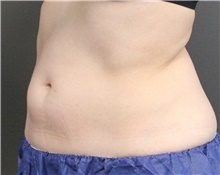 Nonsurgical Fat Reduction After Photo by Jennifer Greer, MD; Mentor, OH - Case 40954