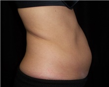 Nonsurgical Fat Reduction Before Photo by Jennifer Greer, MD; Mentor, OH - Case 40954