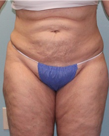 Liposuction After Photo by Jennifer Greer, MD; Mentor, OH - Case 41018