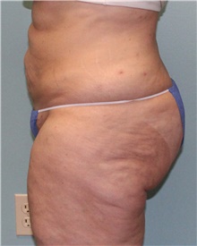 Liposuction After Photo by Jennifer Greer, MD; Mentor, OH - Case 41018