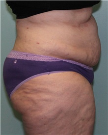 Liposuction Before Photo by Jennifer Greer, MD; Mentor, OH - Case 41018